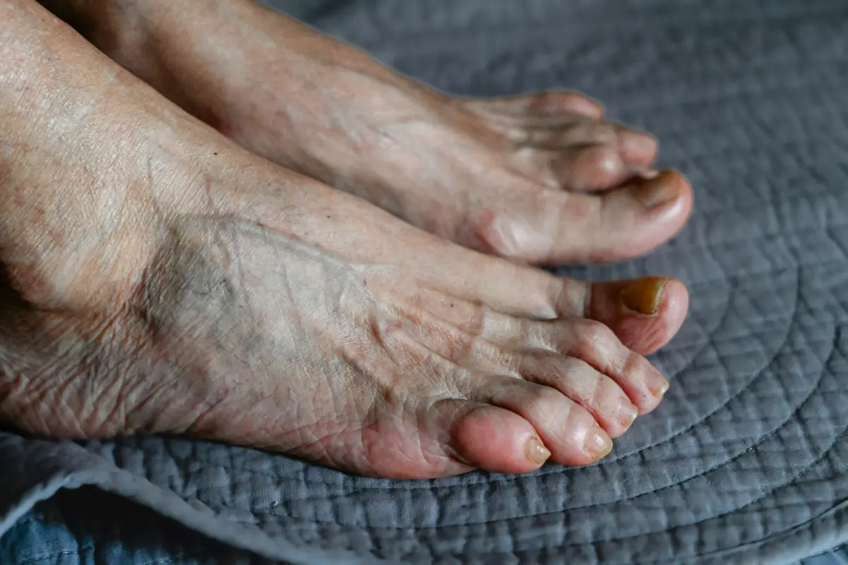 Bunions 2