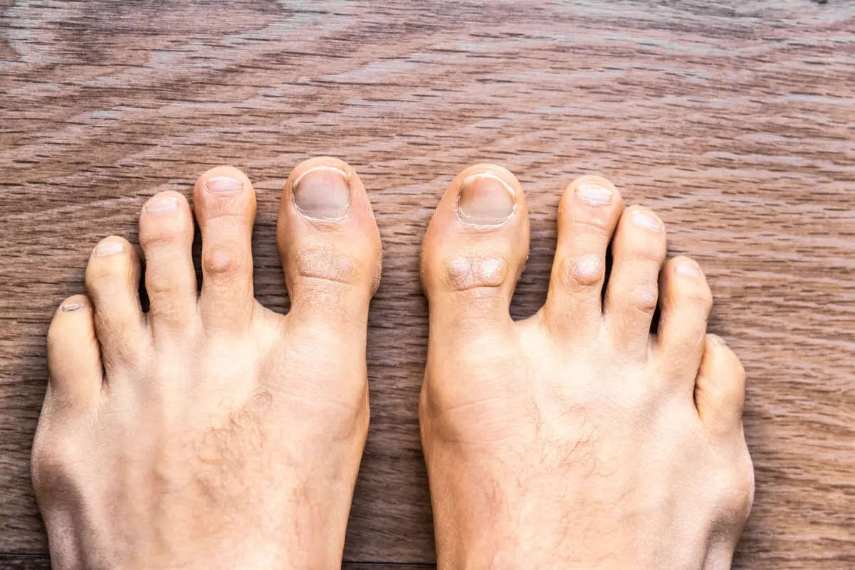 Bunions 4