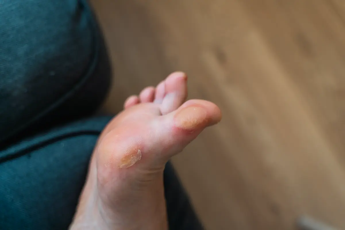 Corn and Callus 1