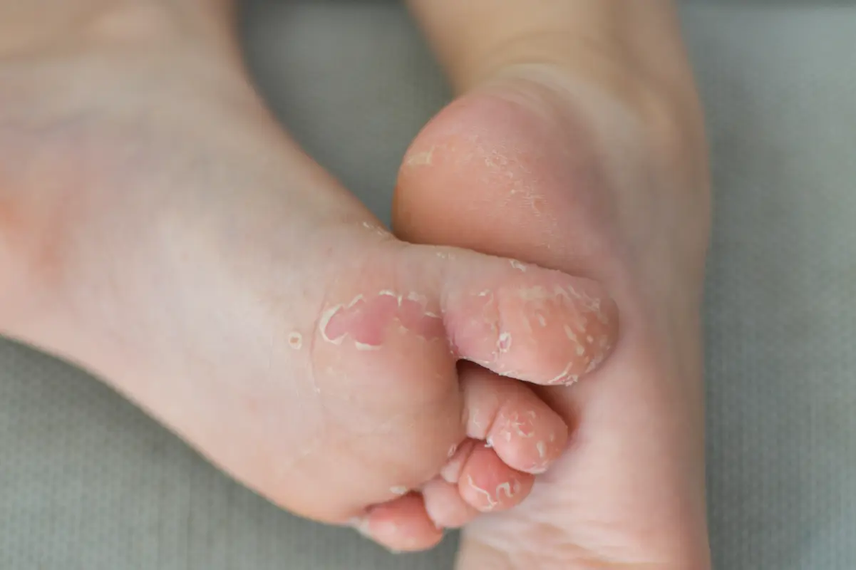 Corn and Callus 2