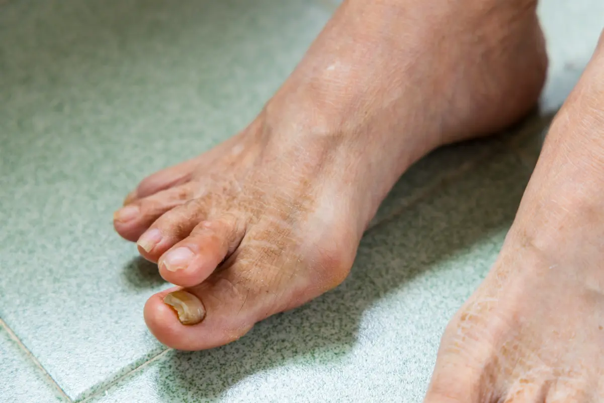 Fungal Toenails 1