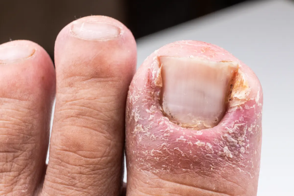 Ingrowing Toenails 32
