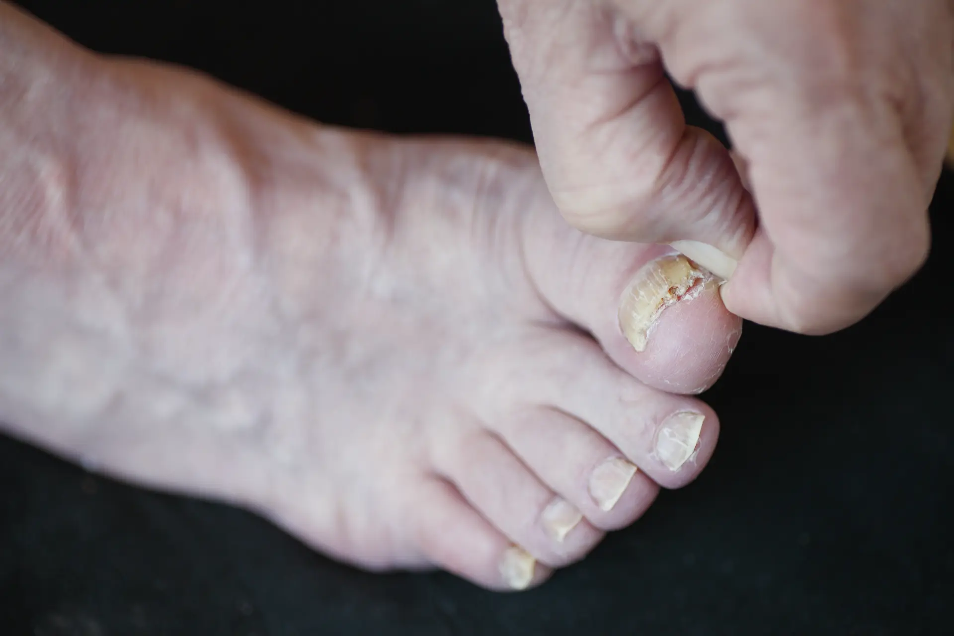 Ingrowing Toenails