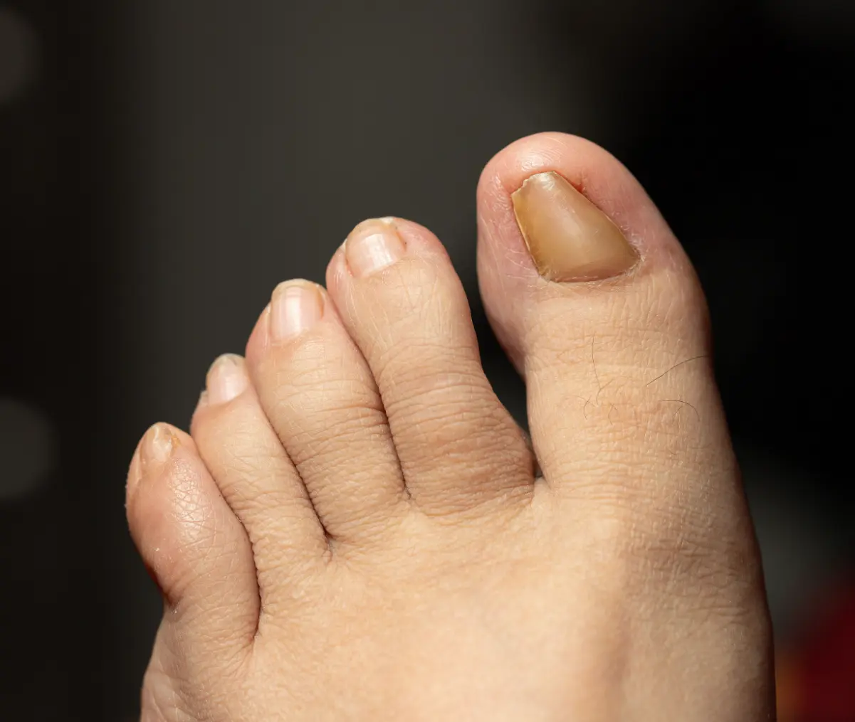 Thickened Toenails 1
