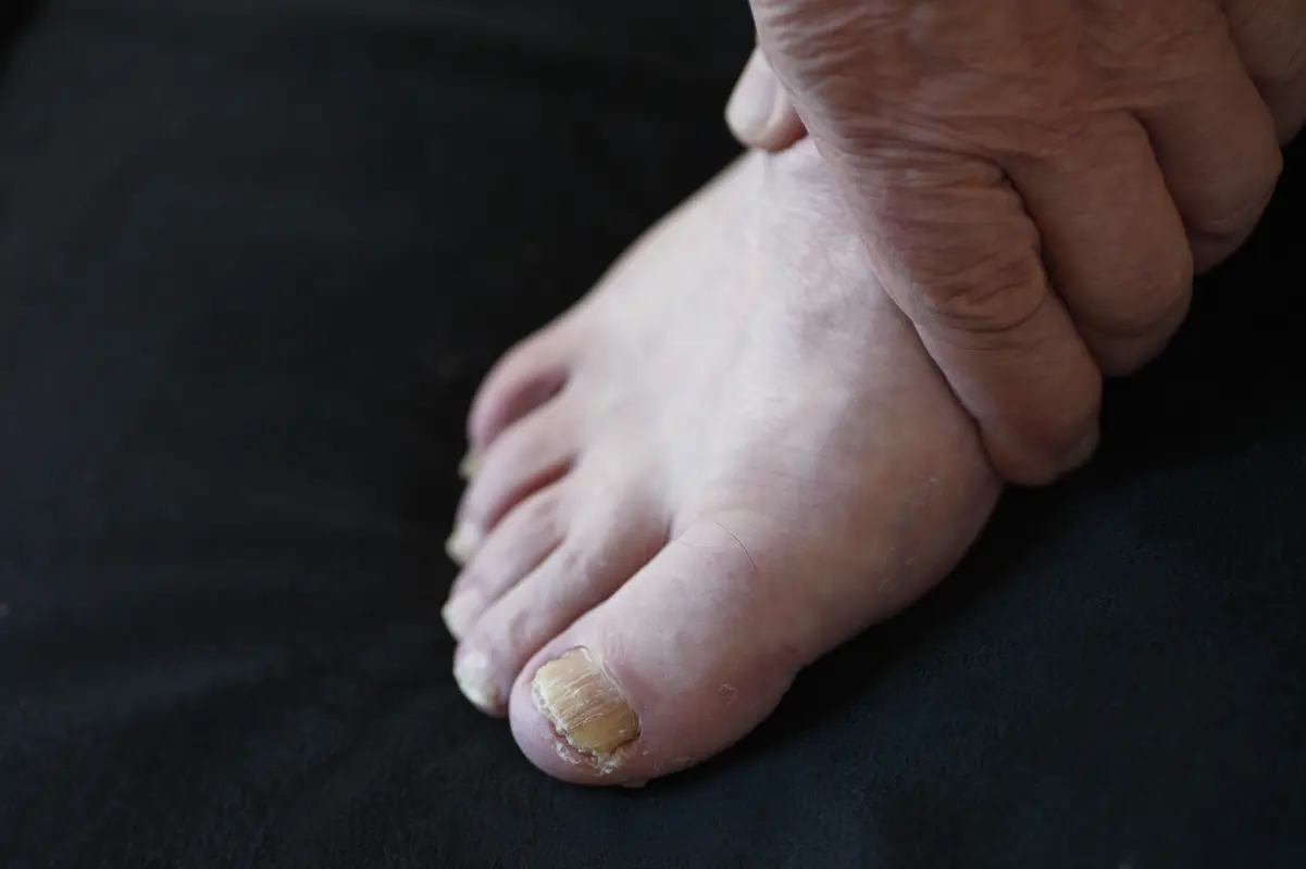 Thickened Toenails 2