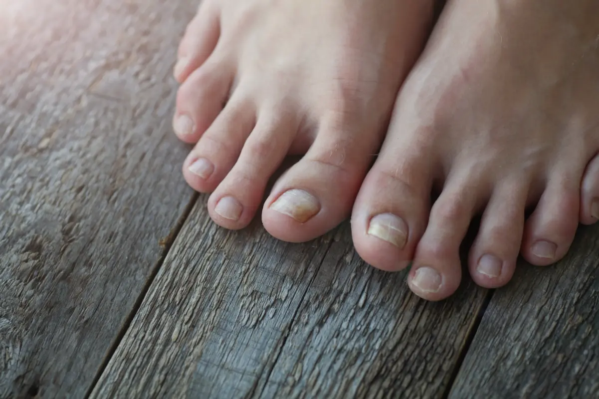 Thickened Toenails 3