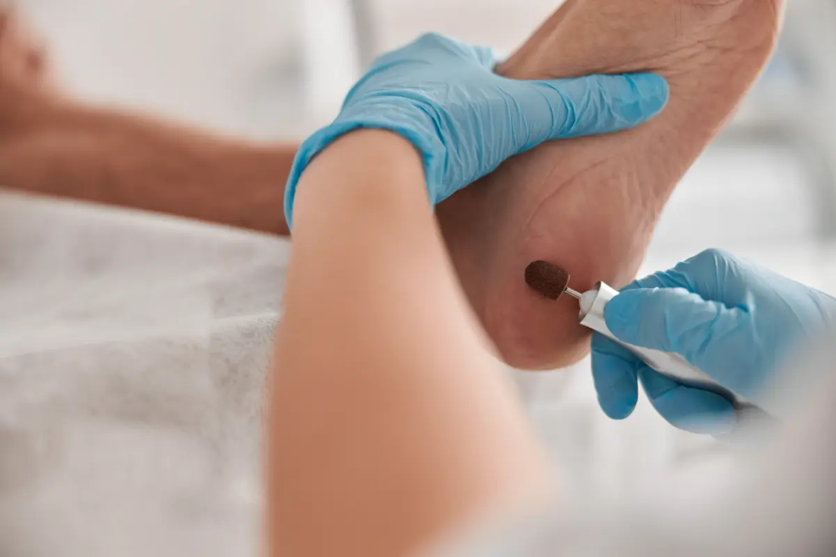 Verruca Treatments 1