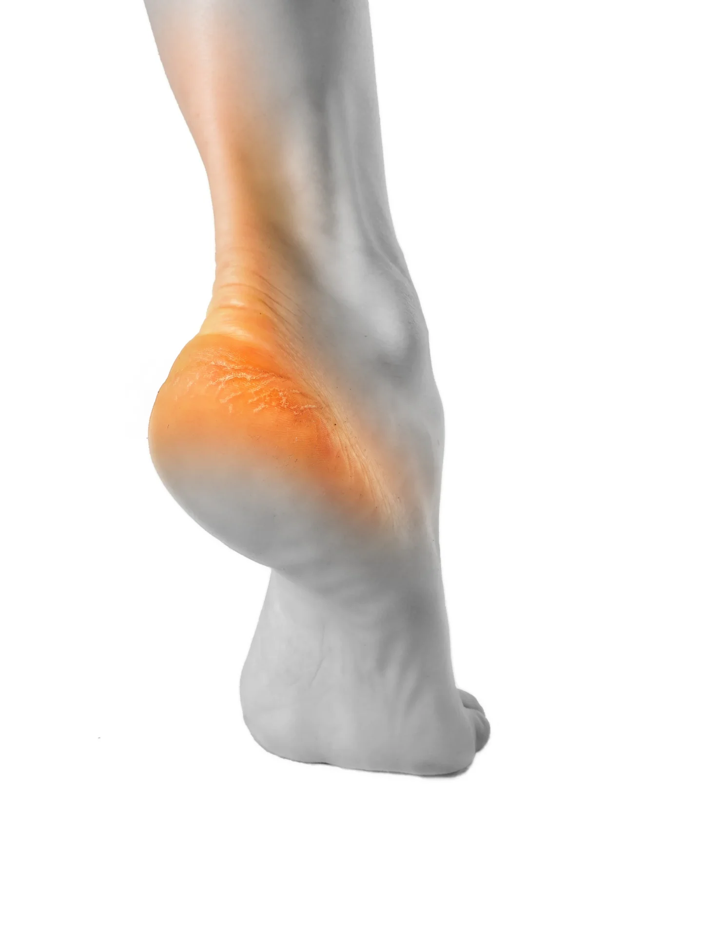 cracked heel closeup on white background 2026 03 26 02 56 53 utc 1
