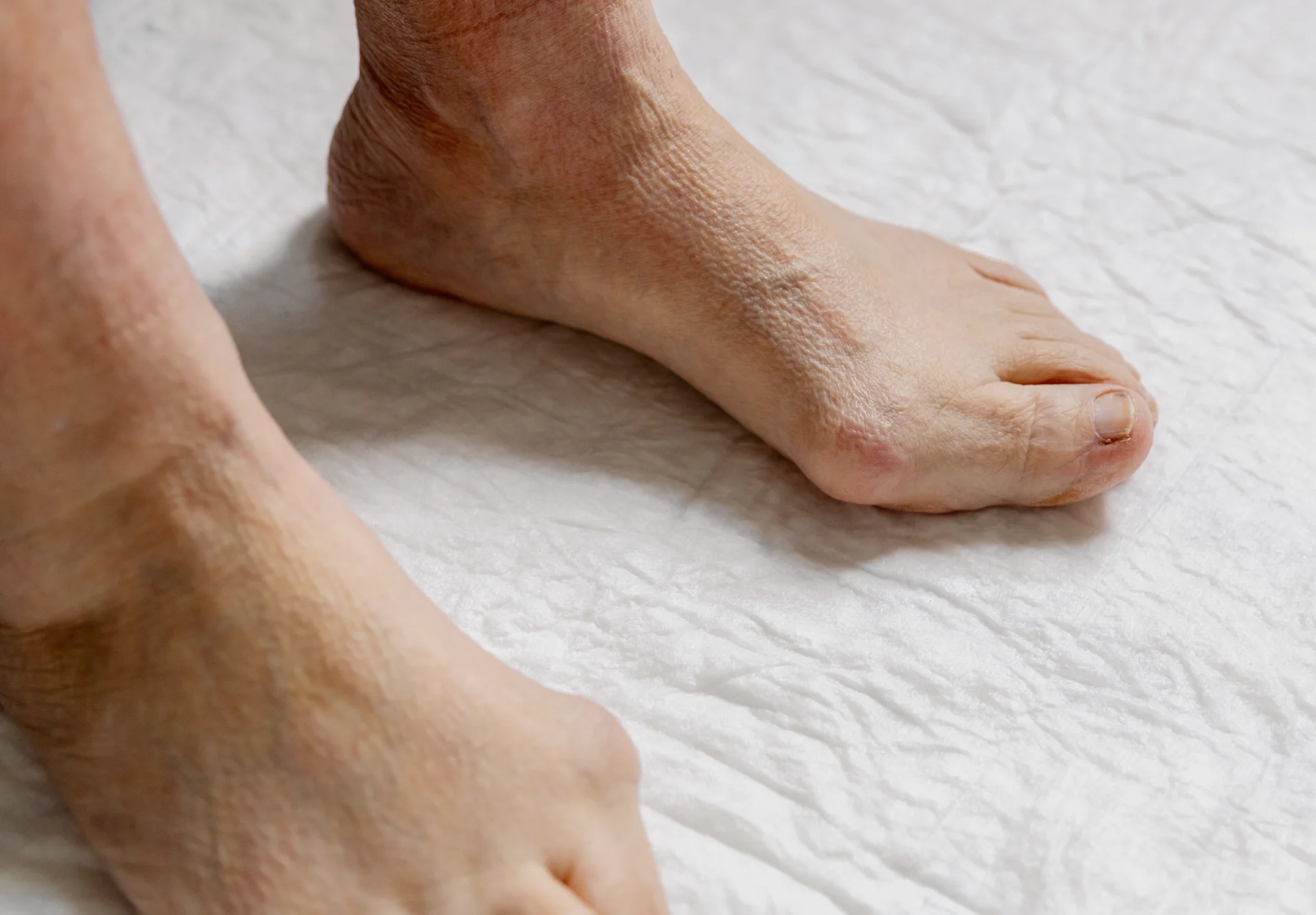 hallux valgus on senior adult foot 2026 03 25 08 11 23 utc 1 1