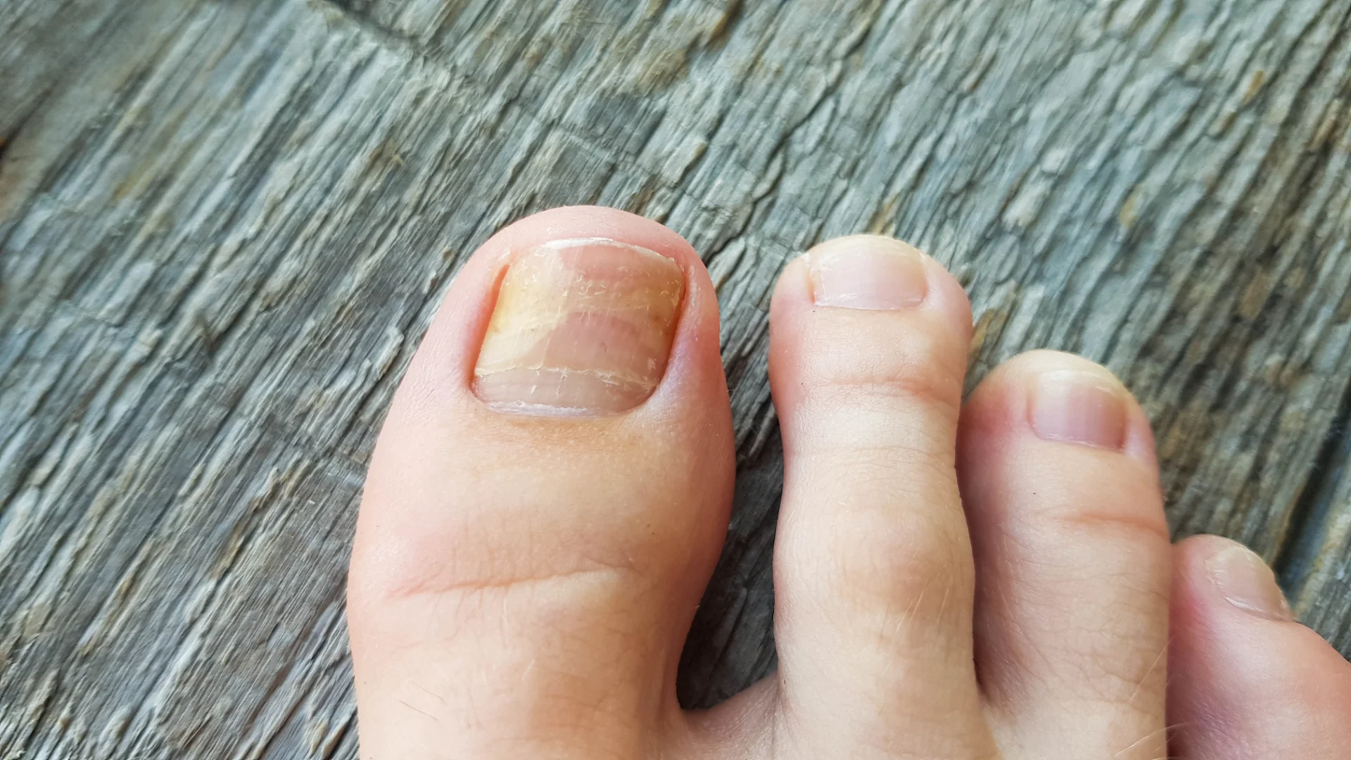 toe nail fungus on the big toe 2026 03 17 00 04 15 utc 1