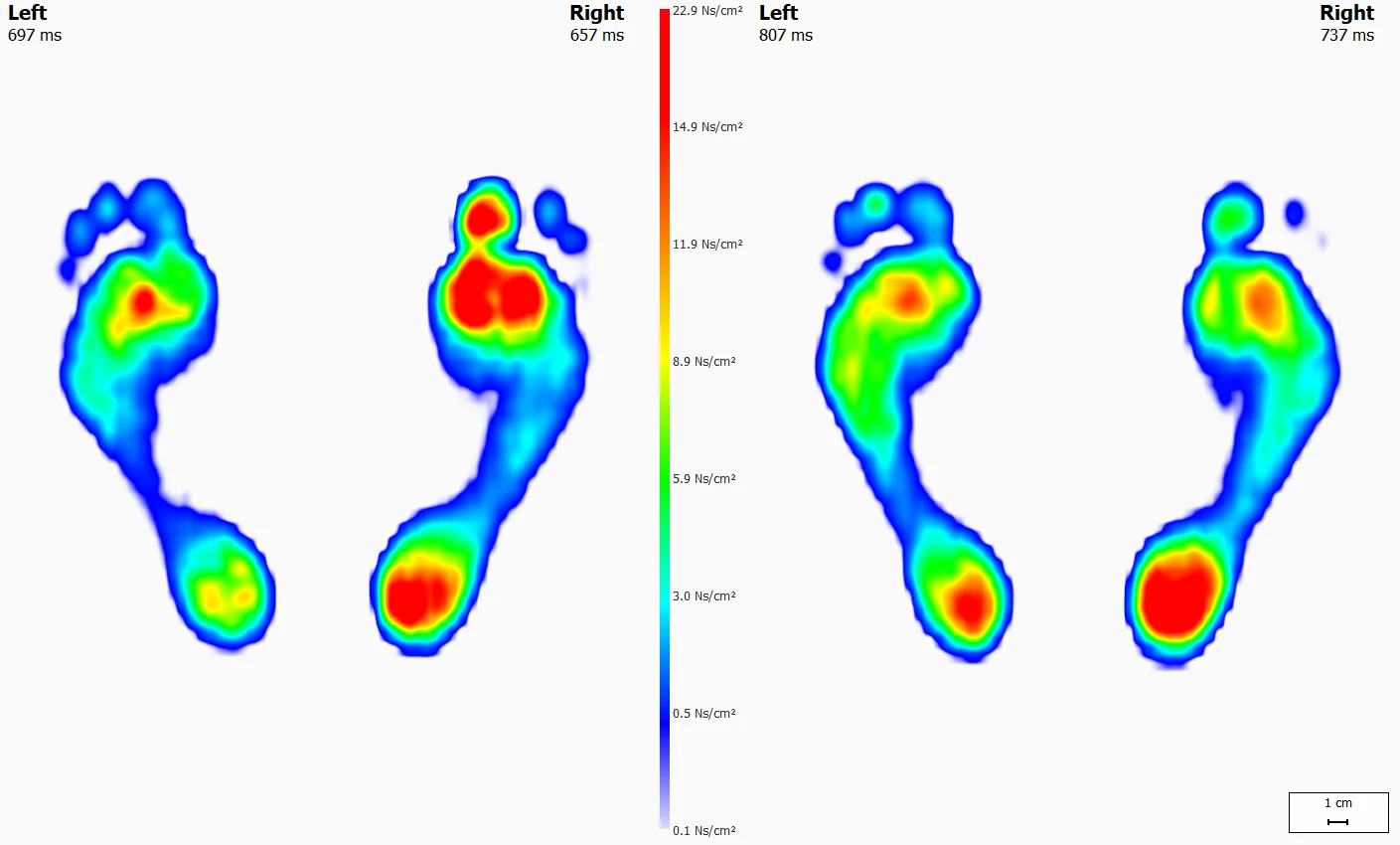 Footscan Comparison Example 2